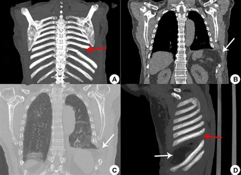 rib tear test|ct scan for rib injury.